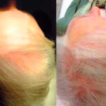 Estudio: Serenoa Repens oral y tópica (Hairgen) en el tratamiento de la alopecia androgenética